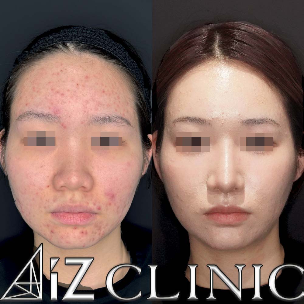 鼻柱下降により鼻柱をしっかりだし鼻を長くした症例