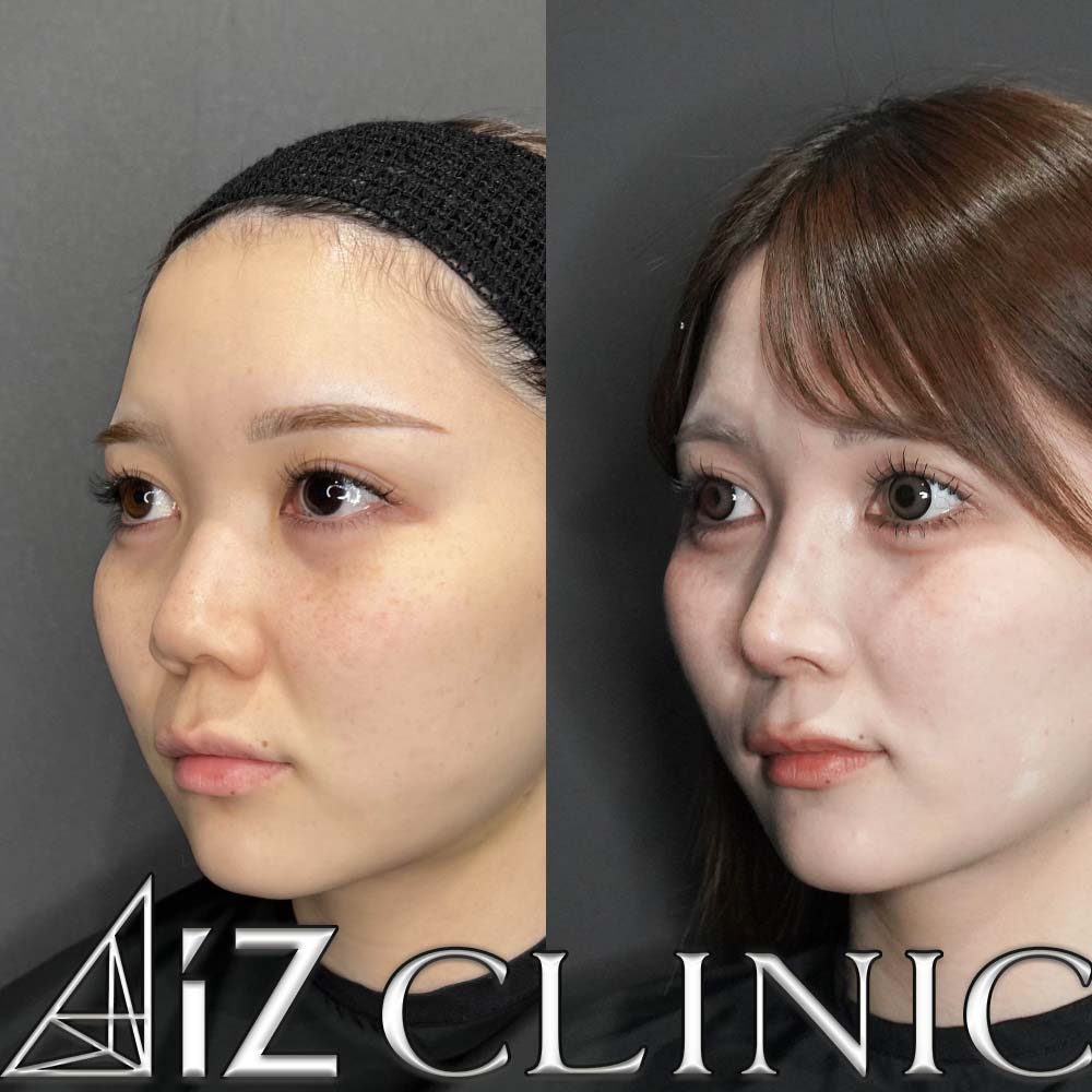 鼻尖形成ストラット法、軟骨移植、鼻中隔延長、鼻柱下降術、プロテーゼの術後６ヶ月