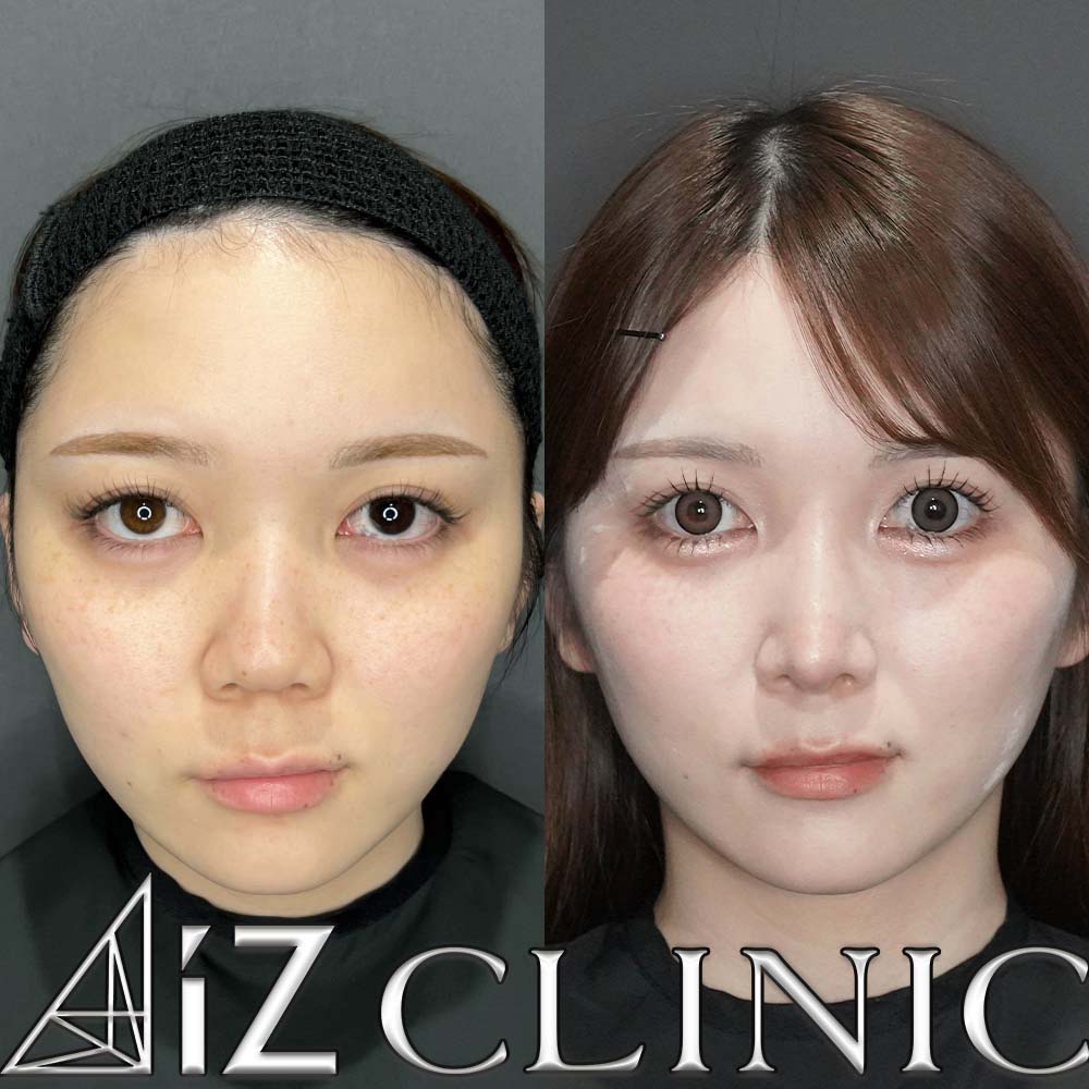 鼻尖形成ストラット法、軟骨移植、鼻中隔延長、鼻柱下降術、プロテーゼの術後6ヶ月