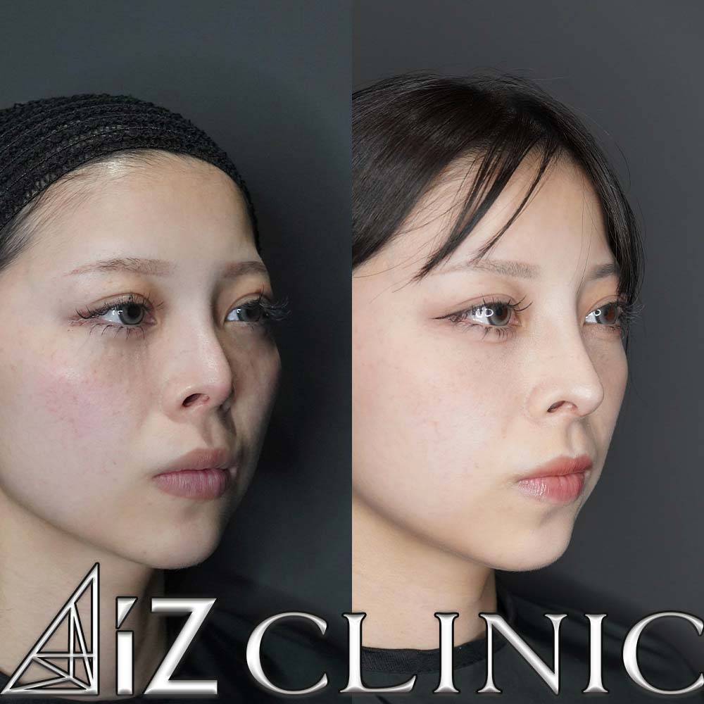 鼻尖形成ストラット法、軟骨移植、鼻中隔延長、鼻柱下降術、プロテーゼ入れ替えの術後1ヶ月