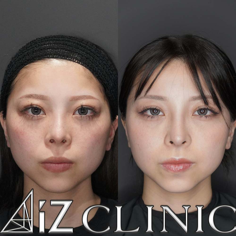 鼻尖形成ストラット法、軟骨移植、鼻中隔延長、鼻柱下降術、プロテーゼ入れ替えの術後1ヶ月