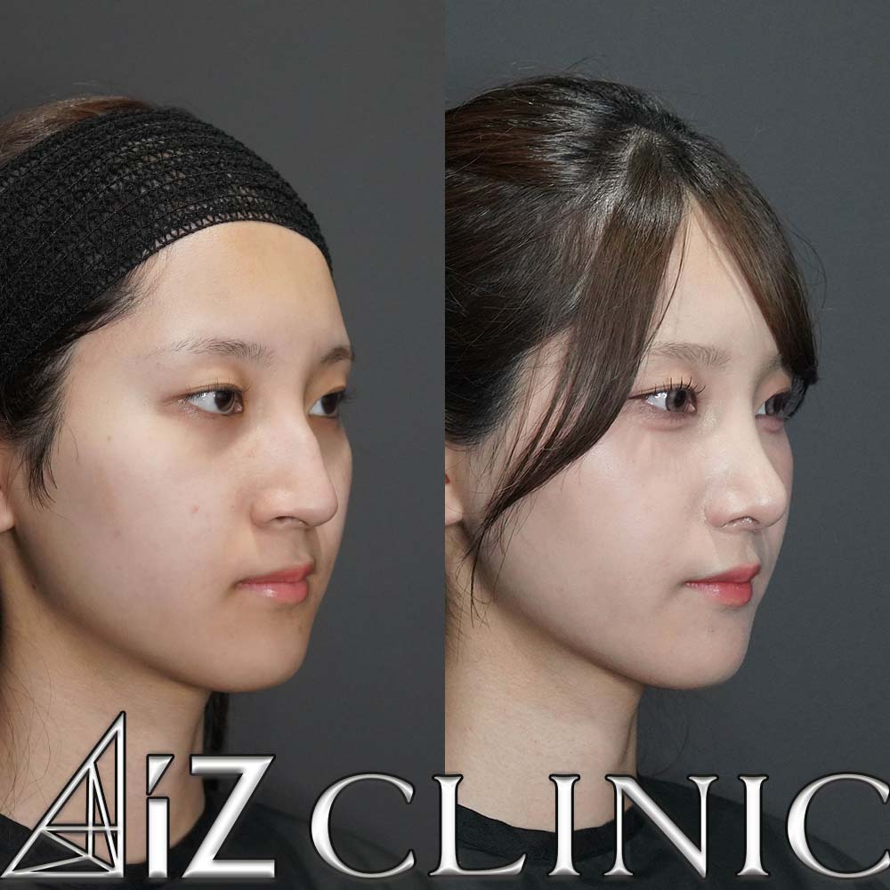 鷲鼻プラス鼻先でスッキリ綺麗に