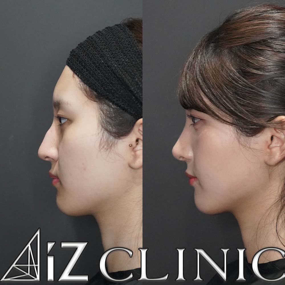 鷲鼻プラス鼻先でスッキリ綺麗に