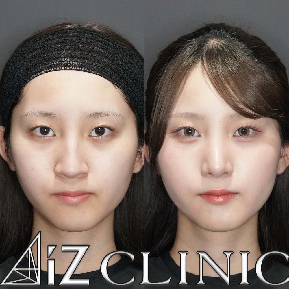 鼻尖形成ストラット法、軟骨移植、鷲鼻削り、ハンプ切除、小鼻縮小の術後3ヶ月