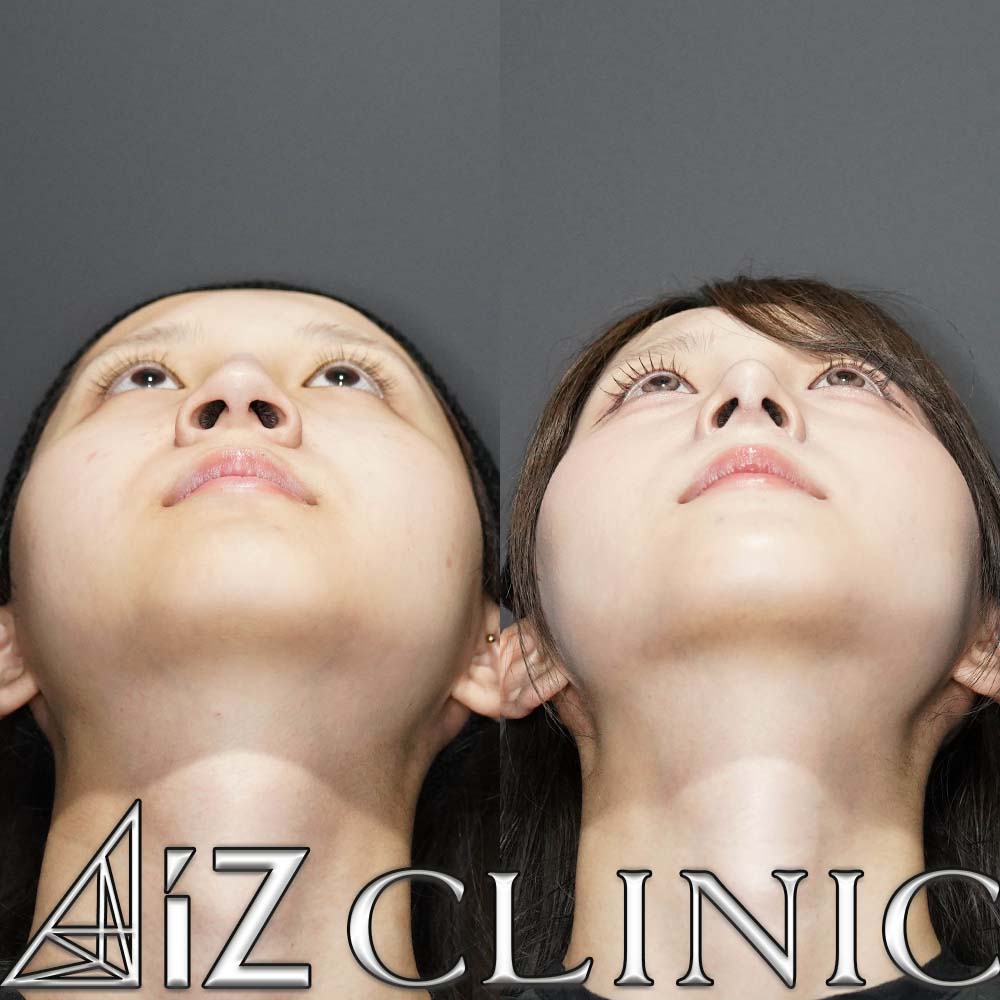 鼻尖形成ストラット法、軟骨移植、鷲鼻削り、ハンプ切除、小鼻縮小の術後3ヶ月