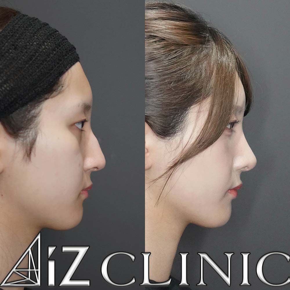 鼻尖形成ストラット法、軟骨移植、鷲鼻削り、ハンプ切除、小鼻縮小の術後3ヶ月