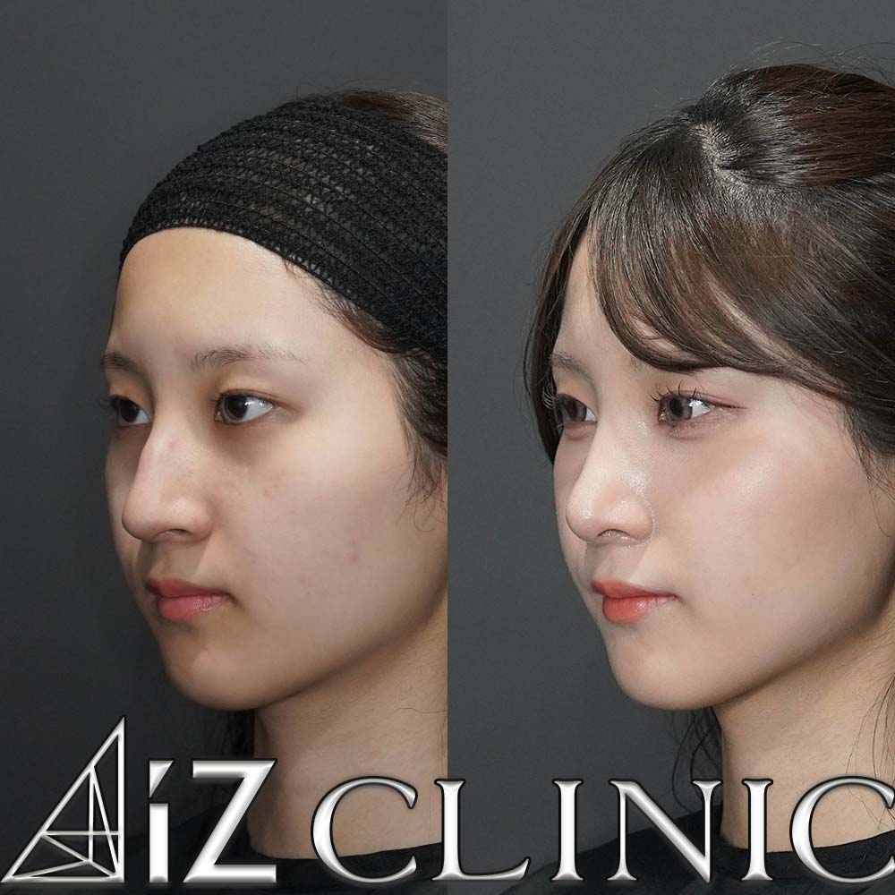 鼻尖形成ストラット法、軟骨移植、鷲鼻削り、ハンプ切除、小鼻縮小の術後3ヶ月